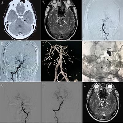 Outcomes in Symptomatic Patients With Vertebrobasilar Dolichoectasia Following Endovascular Treatment